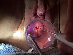 Elettro-sondaggio degli organi genitali rasati con speculum